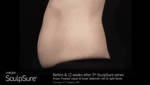 BA_Animated_SculpSure_Doherty_Core_2Tx_12Weeks_01_42_compressed-min