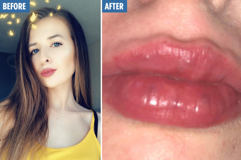 Hyaluron Pen • LA Longevity