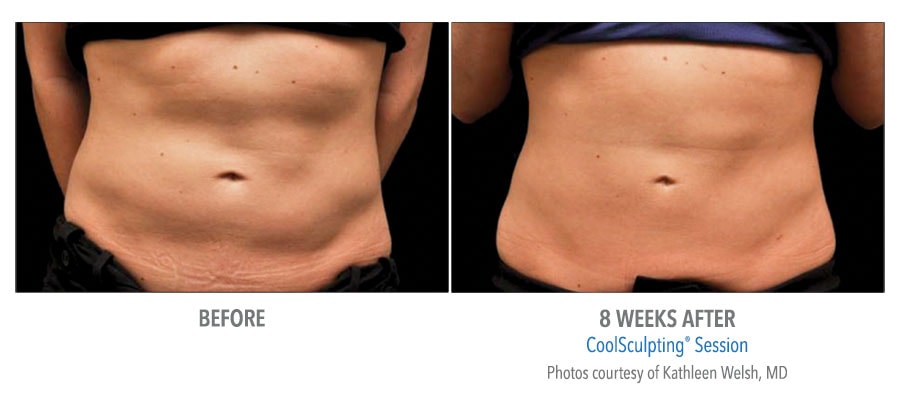 CoolSculpting Before After Abs
