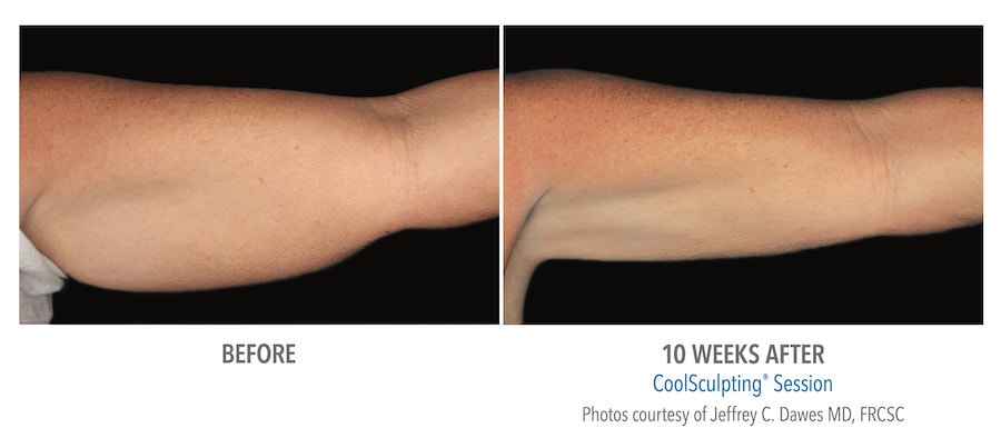 CoolSculpting Before After Arms