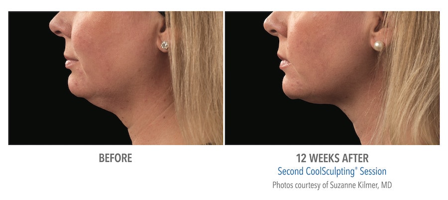 CoolSculpting Before After Chin
