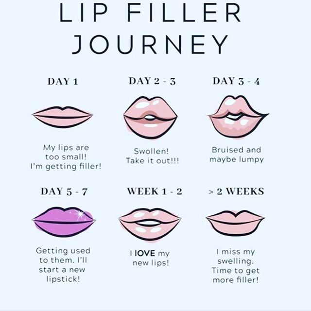 lip-filler-journey-what-to-expect-la-longevity