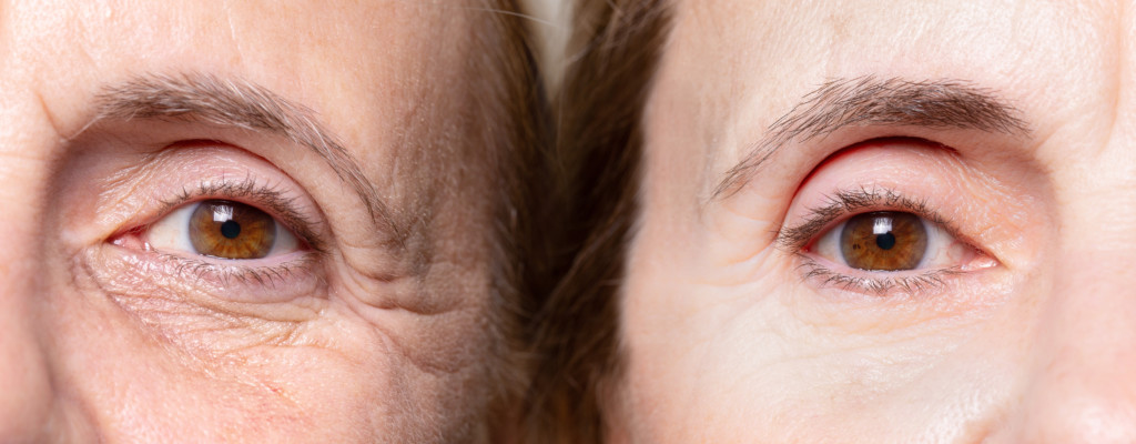 botox-how-i-lift-my-hooded-eyes-as-i-age-la-longevity